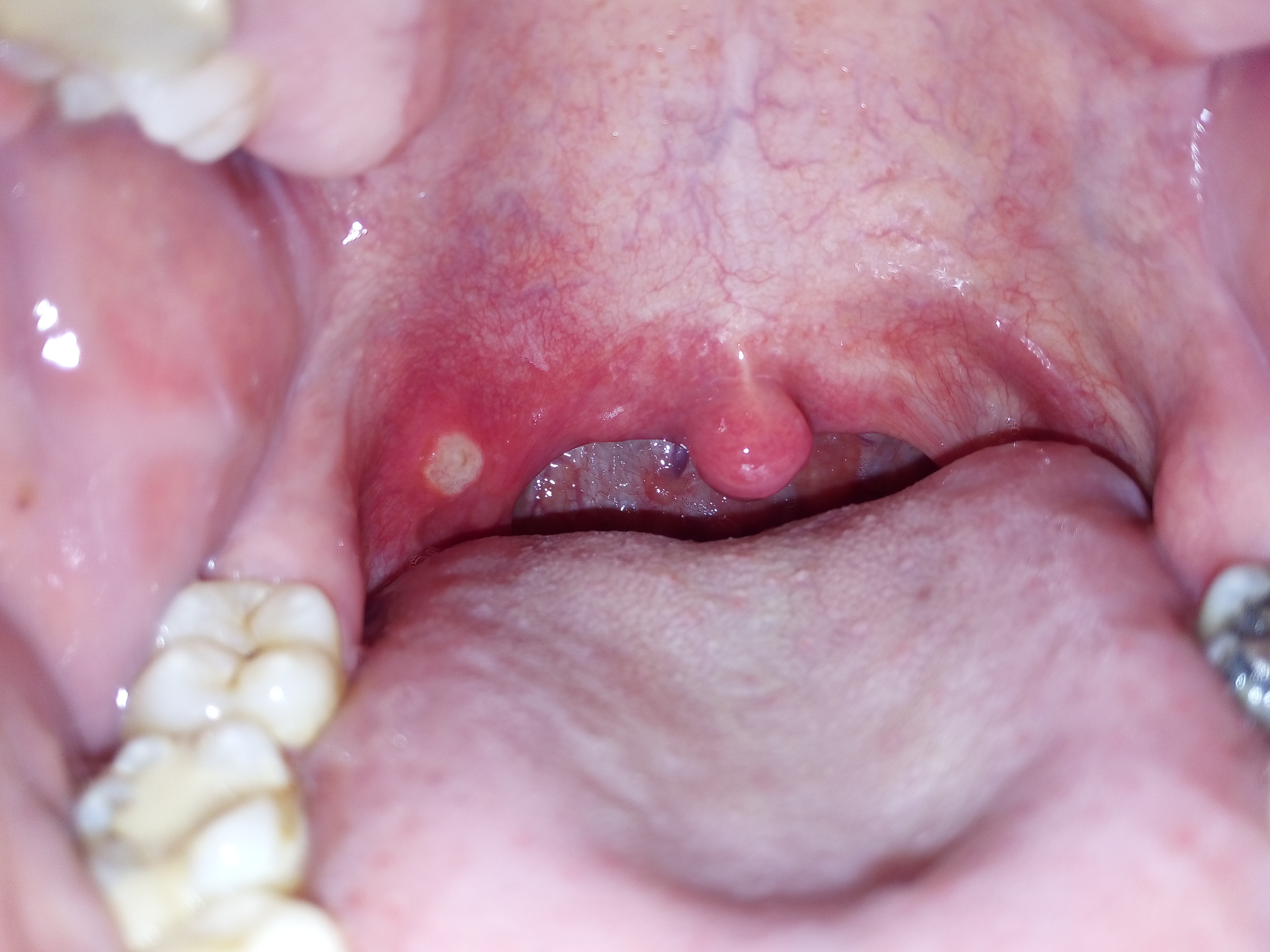Hva er⁣ årsakene‍ til munnsår?